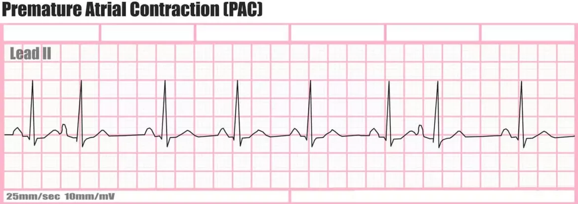 Premature Atrial Contractio