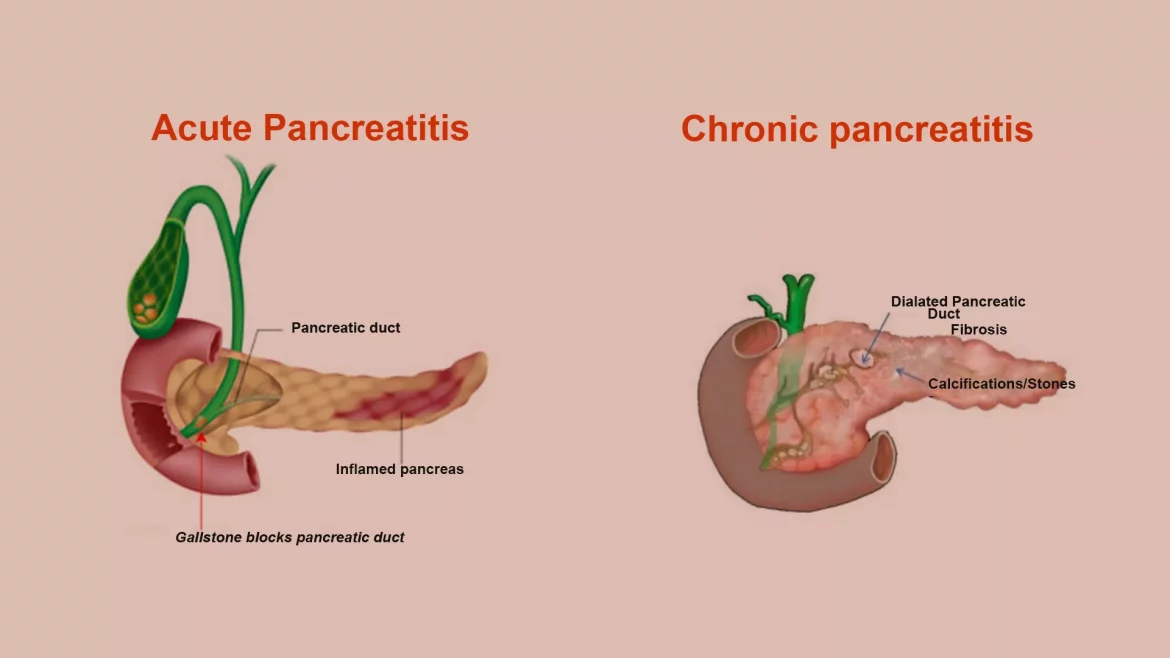 Acute Pancreatitis Cause Hypotension