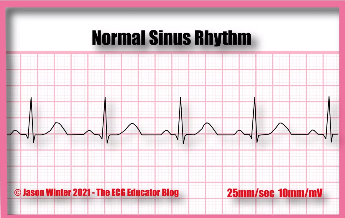 Arrhythmia in Ecg