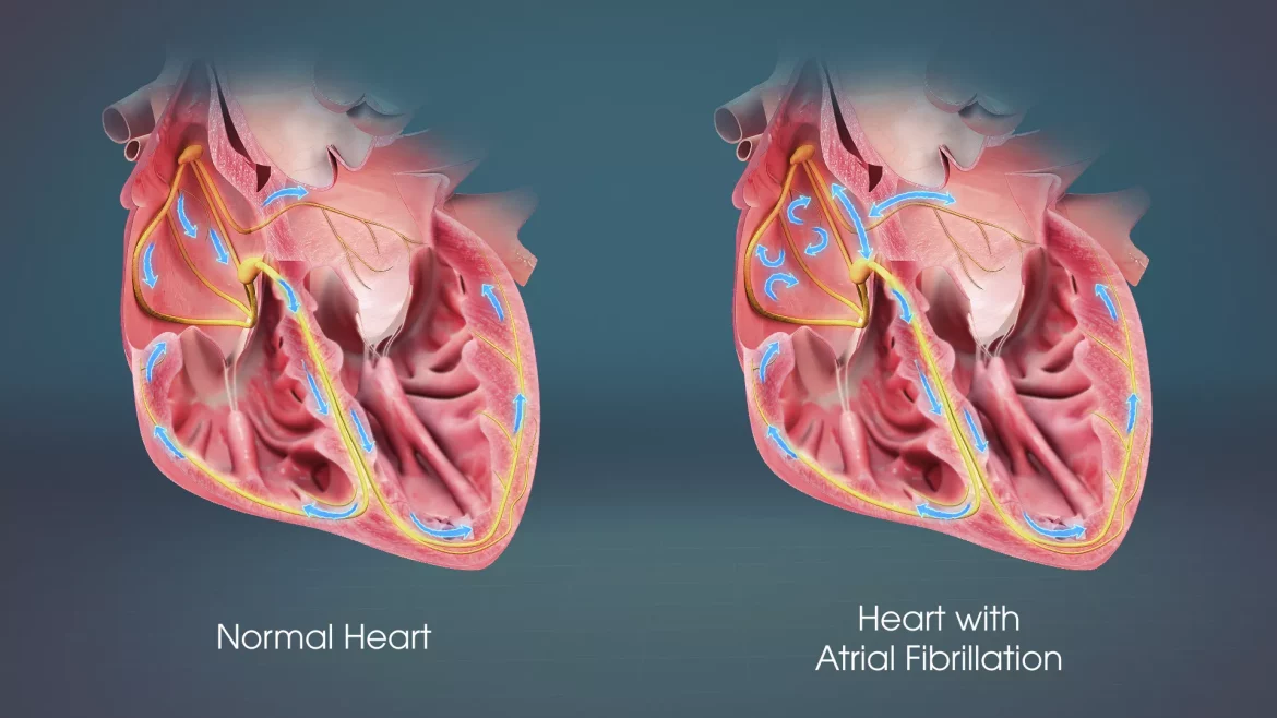Atrial Fibrillation