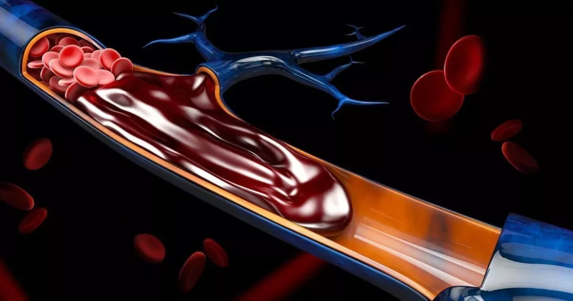 Blood Clot Cause Arrhythmia