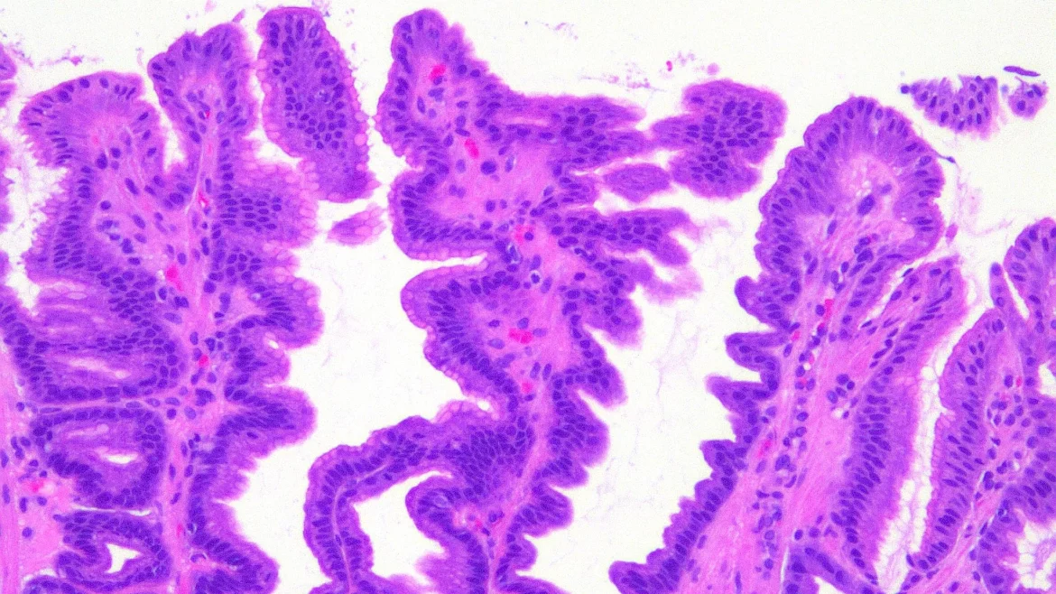 Congestive Gastropathy
