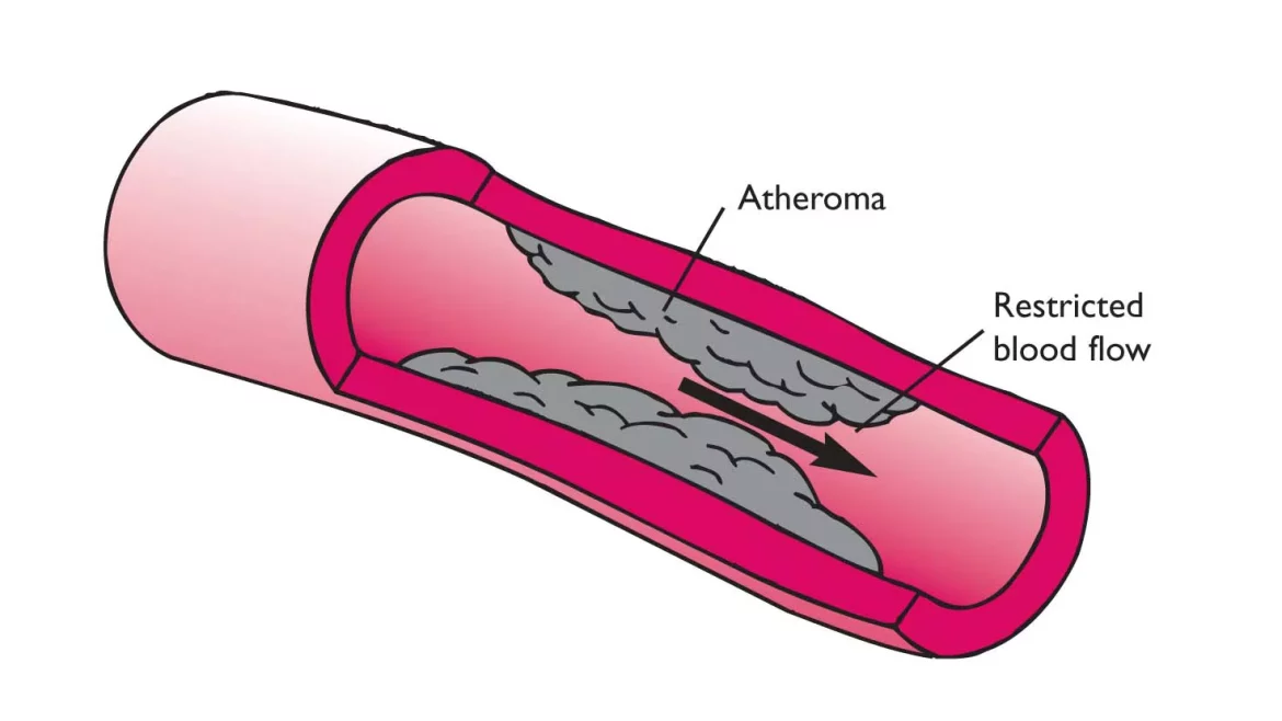 Coronary Heart Disease