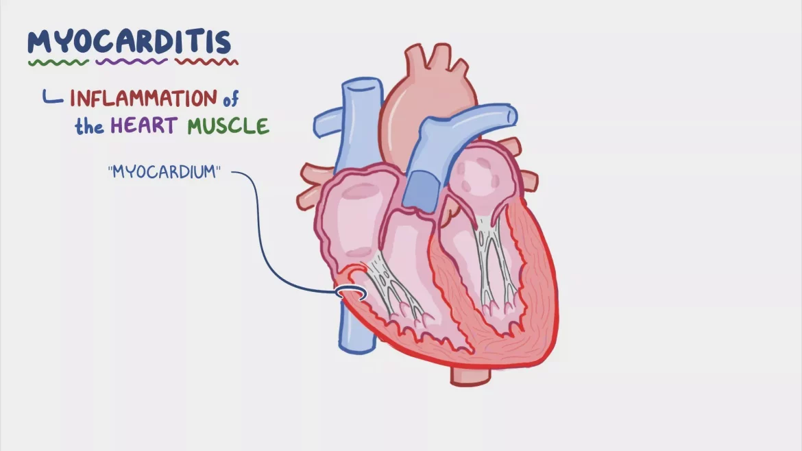Myocarditis