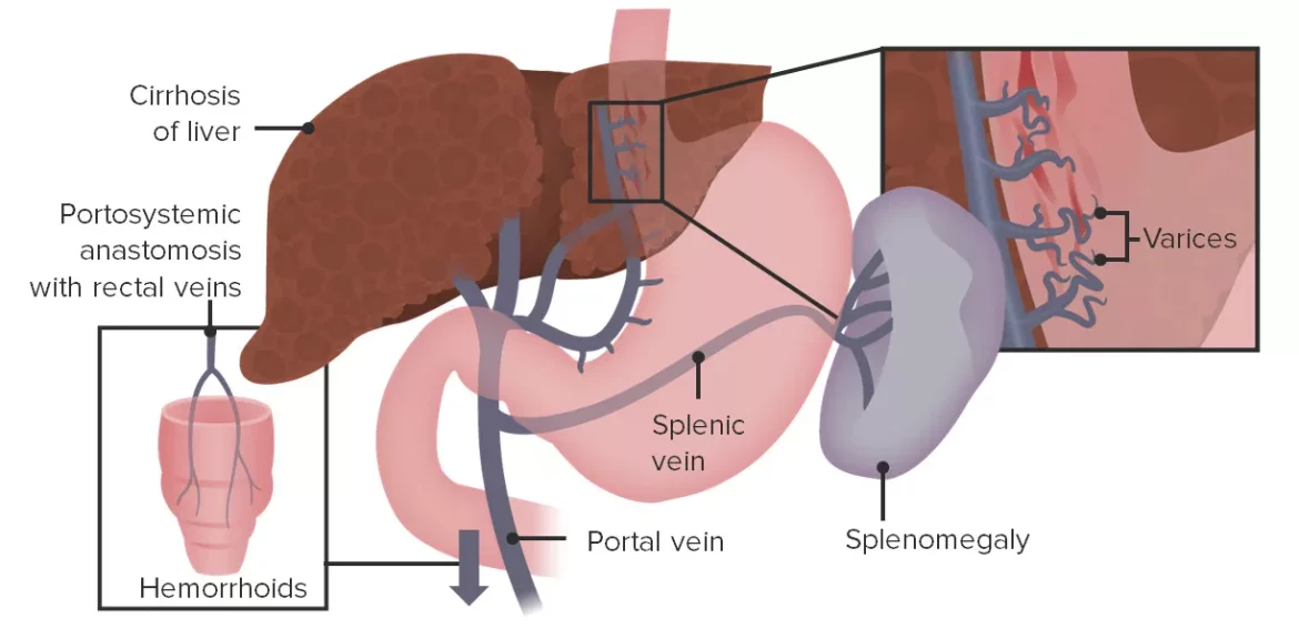 Portal Hypertension