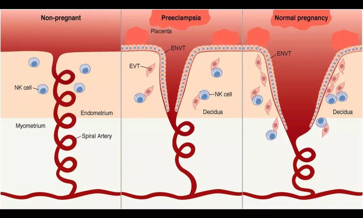 Pre Eclampsia