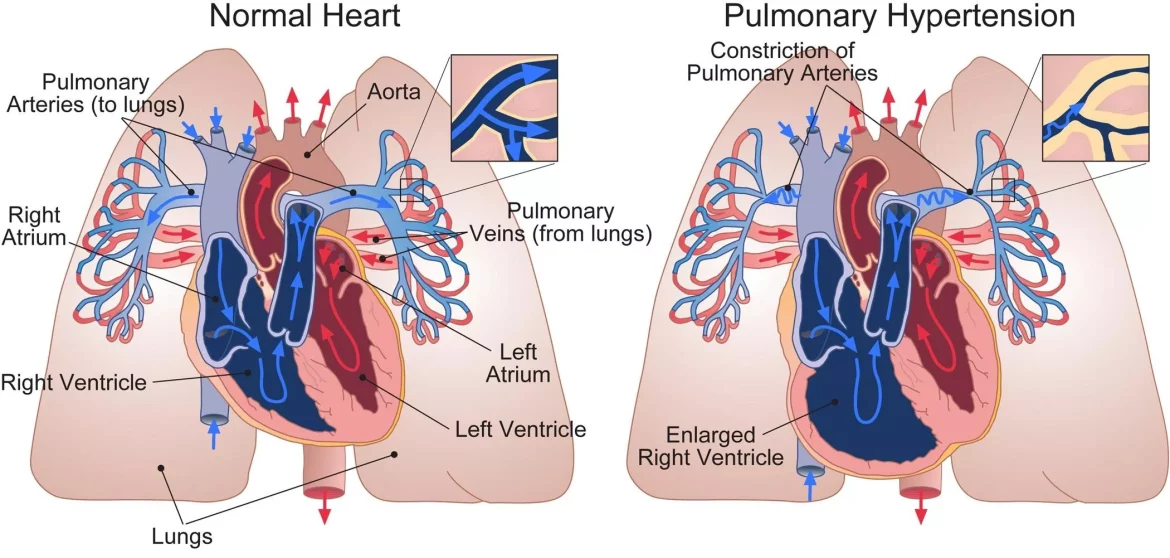 Pulmonary Hypertension