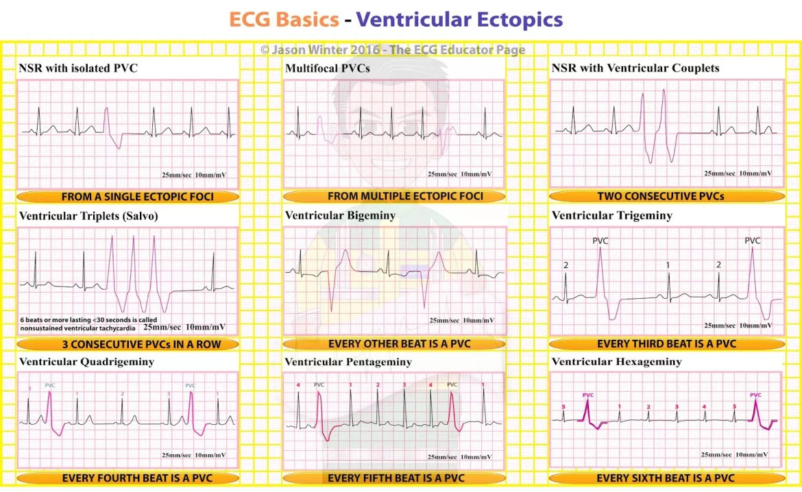 Ventricular Arrhythmia