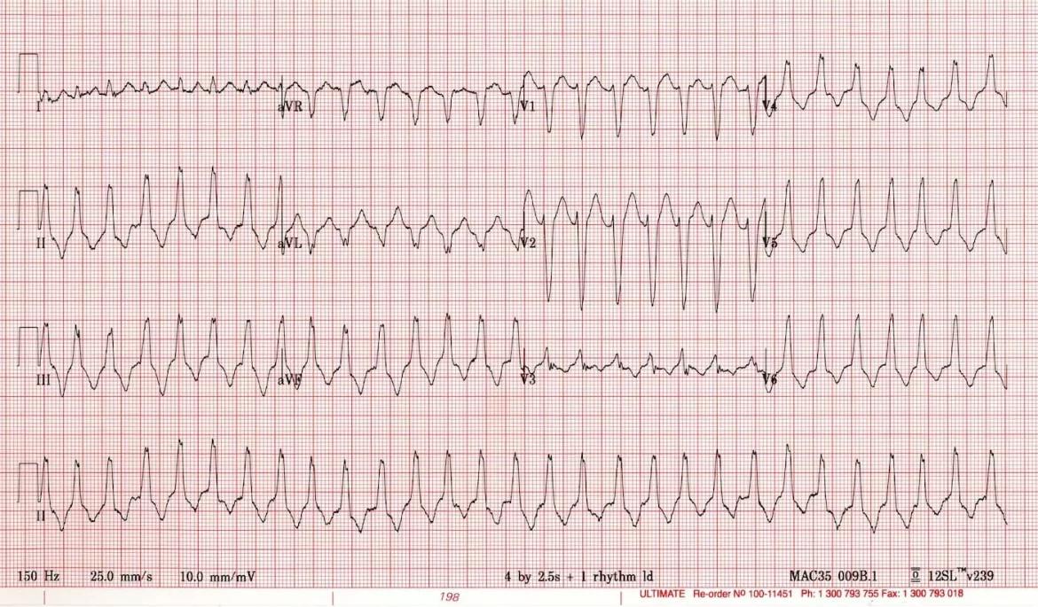 Wide Qrs