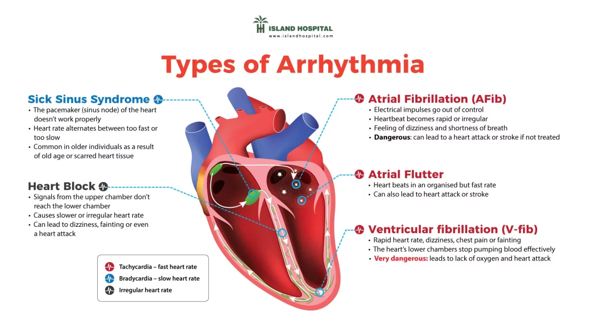 arrhythmia