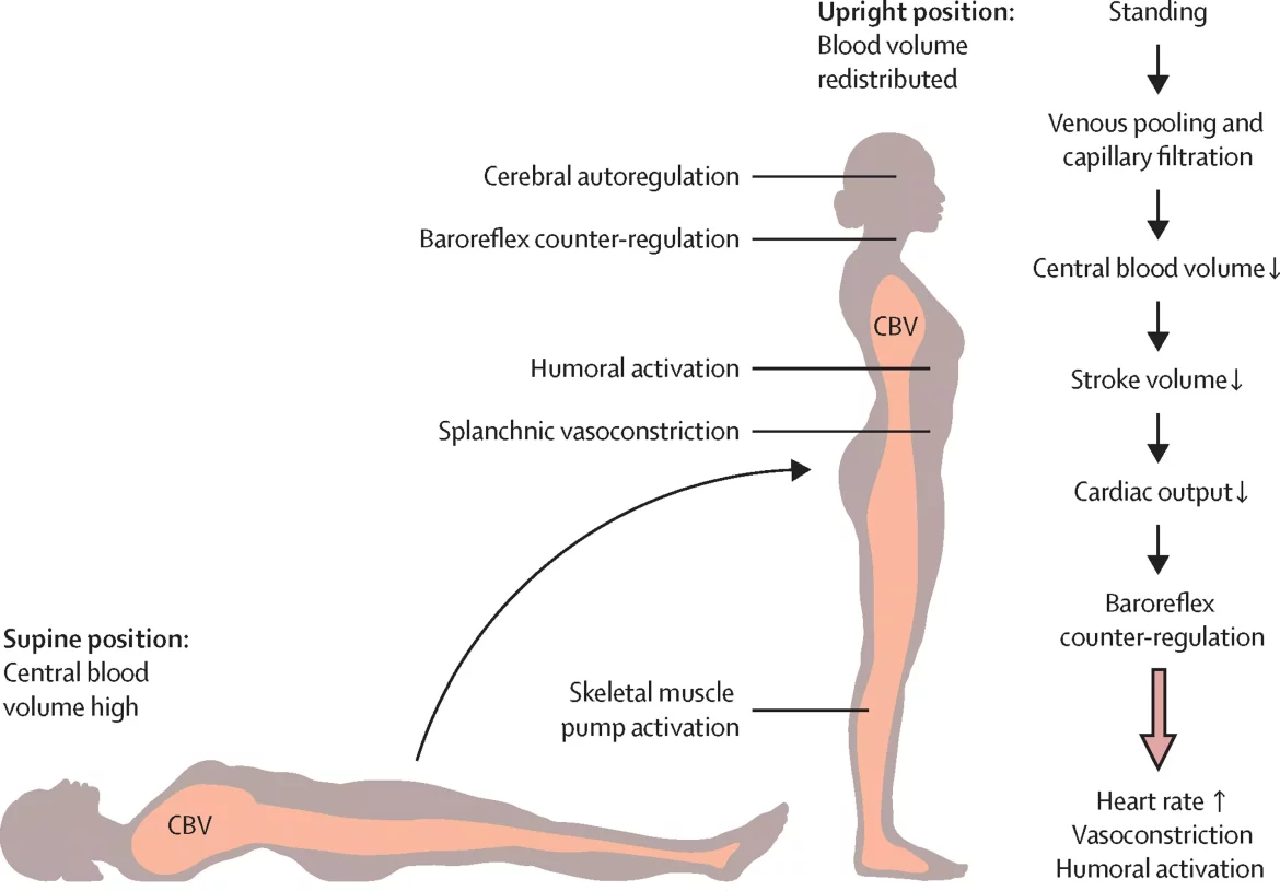Orthostatic Hypertension