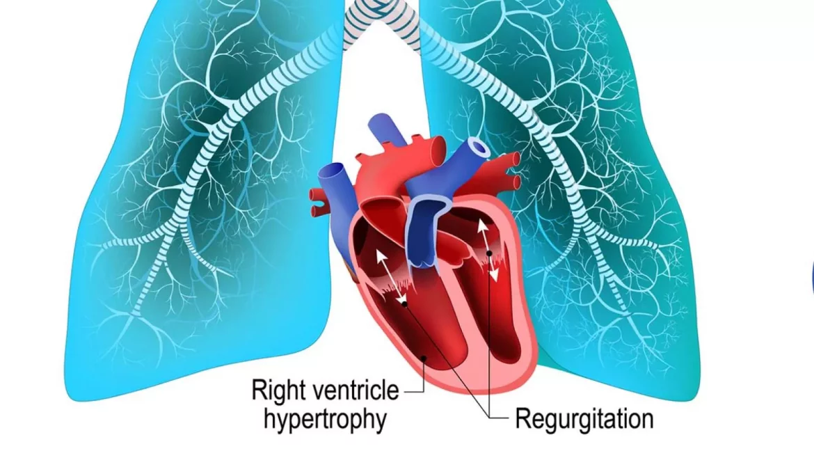 Advanced Hypertension
