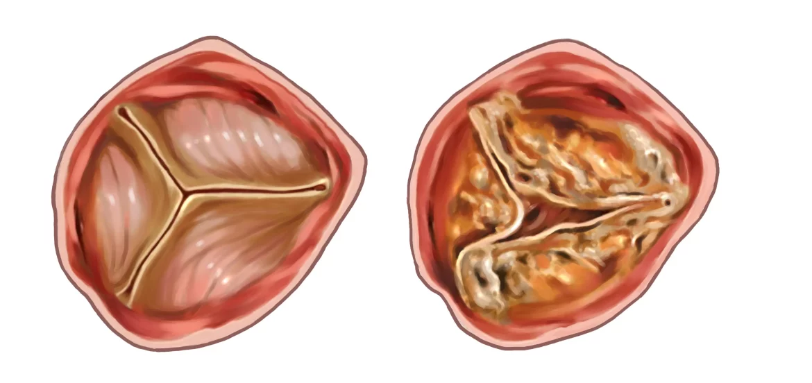 Aortic Valve Disease