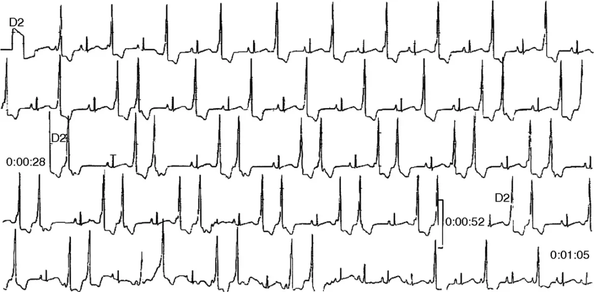 Arrhythmia in Newborns