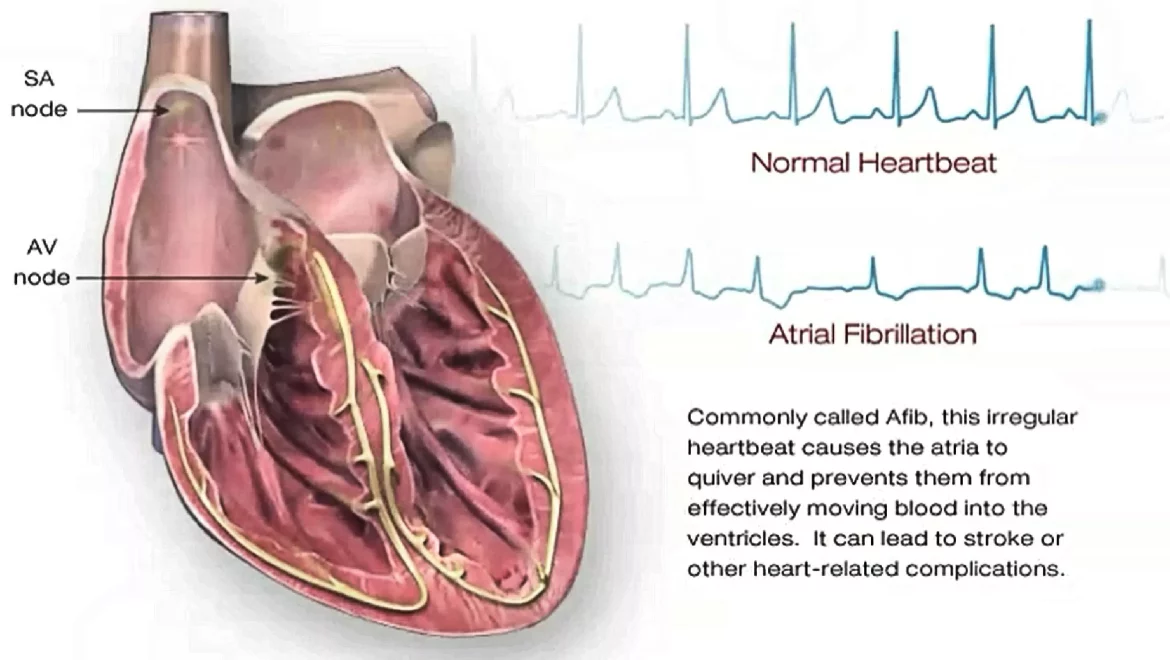 Atrial Fibrillation