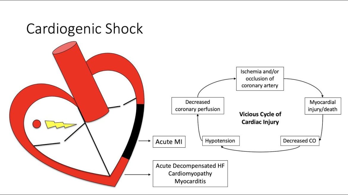 Cardiogenic Shock