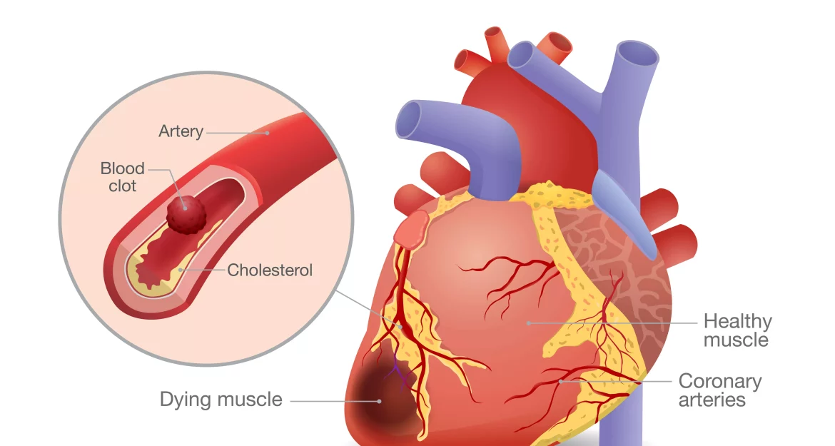 Chronic Heart Failure
