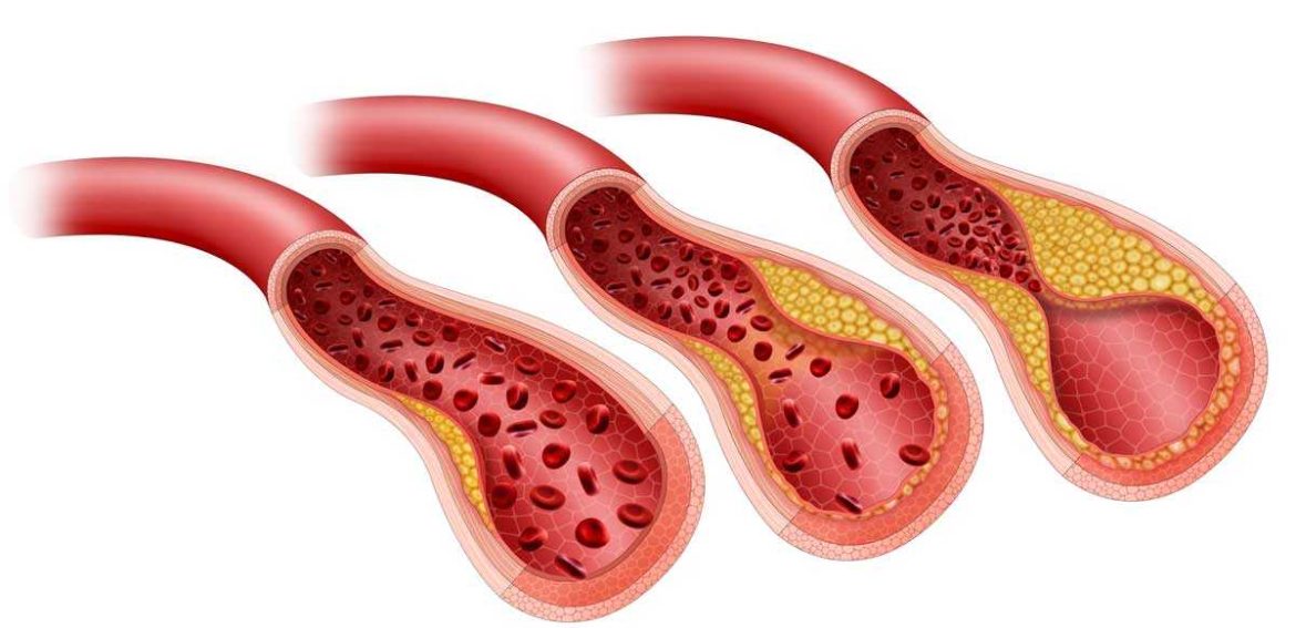 Coronary Artery Disease