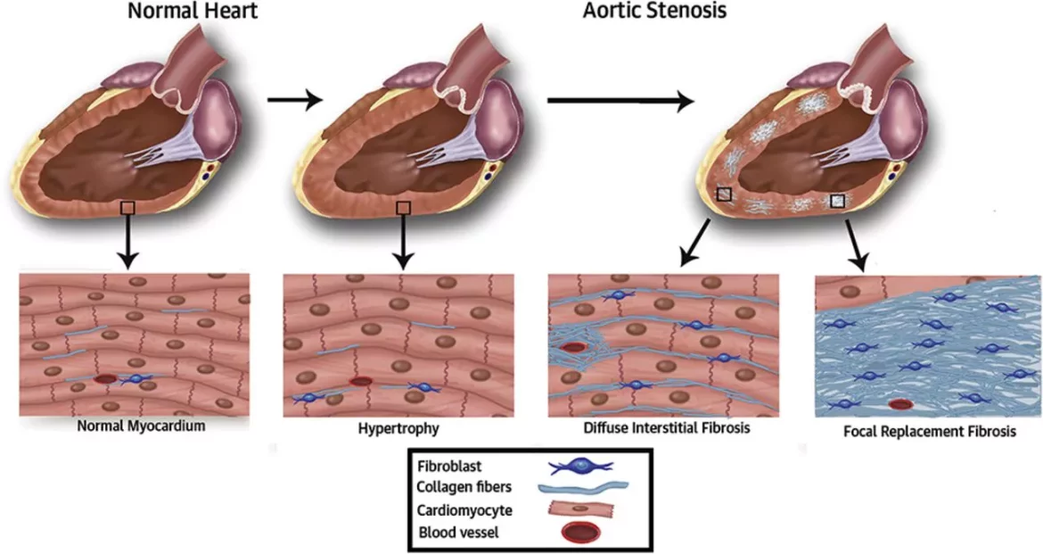 Diastolic Dysfunction