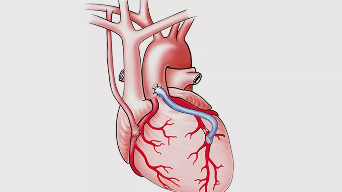 Dilated Coronary Arteries