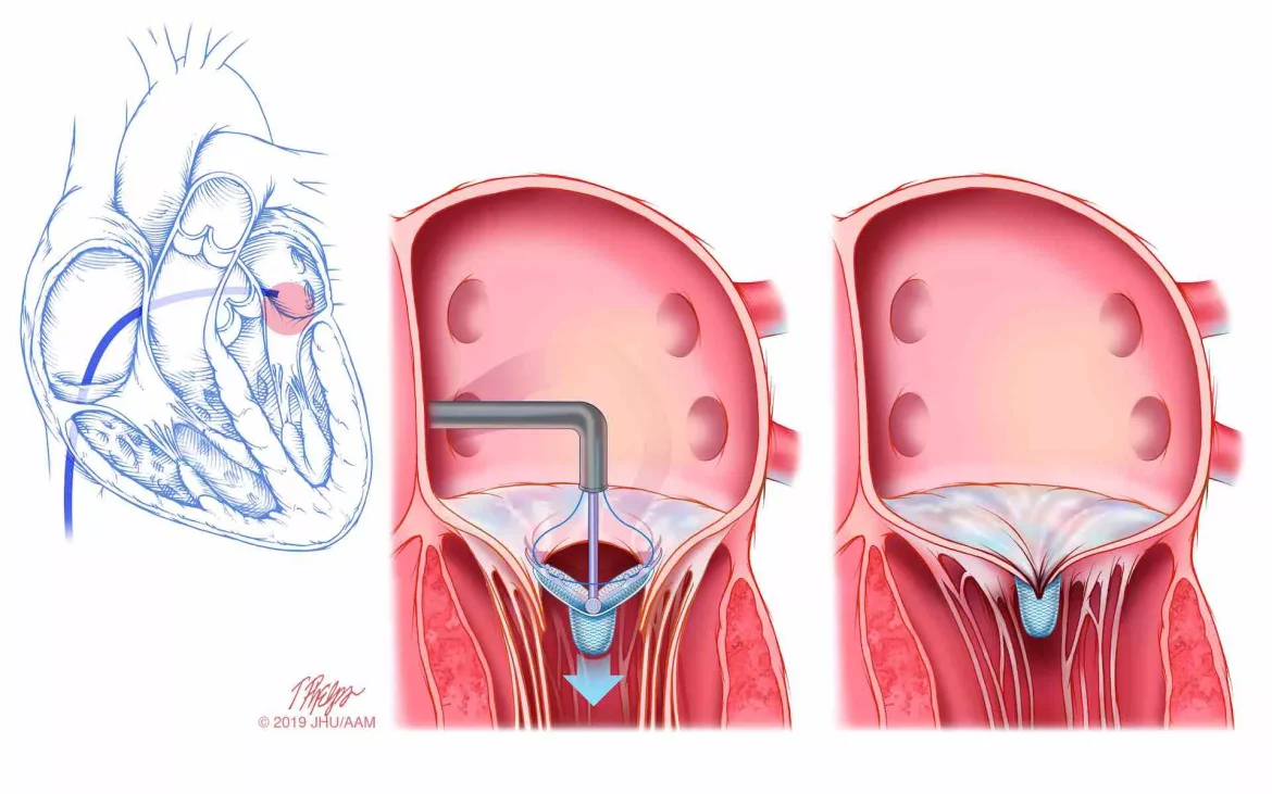 Failed Heart Valve Replacement