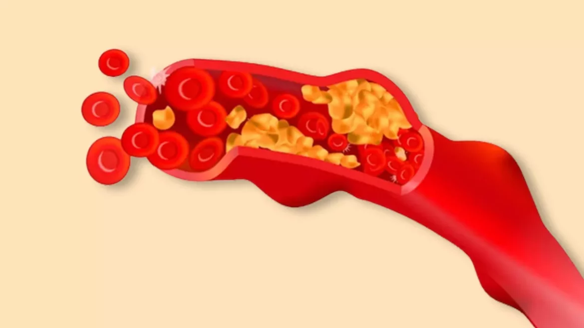Heart Artery Blockage