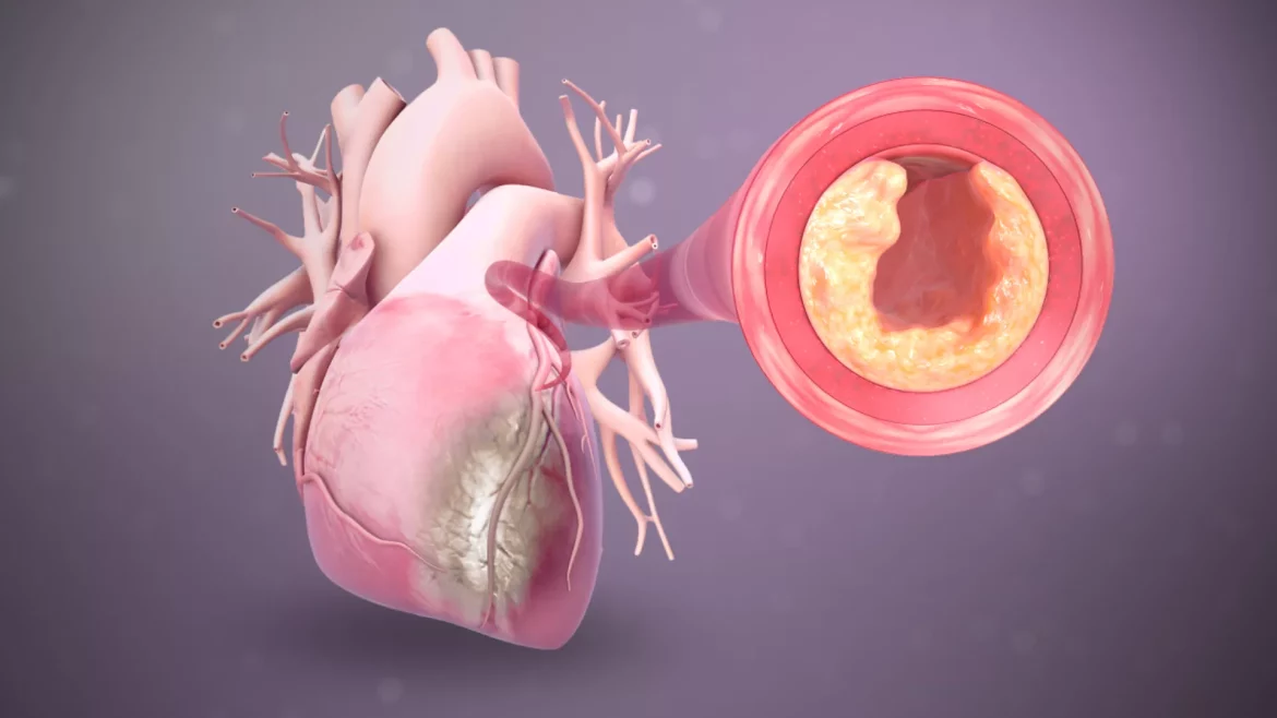 Heart Inflammation