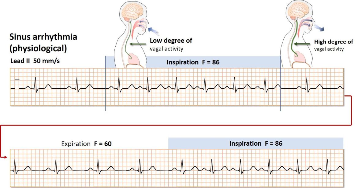Obvious Sinus Arrhythmia