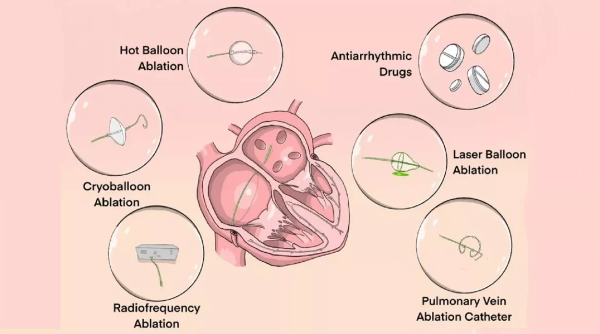 Paroxysmal Atrial Fibrillation