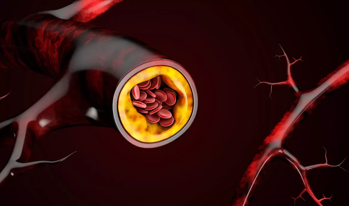 Plaque Buildup in Your Arteries