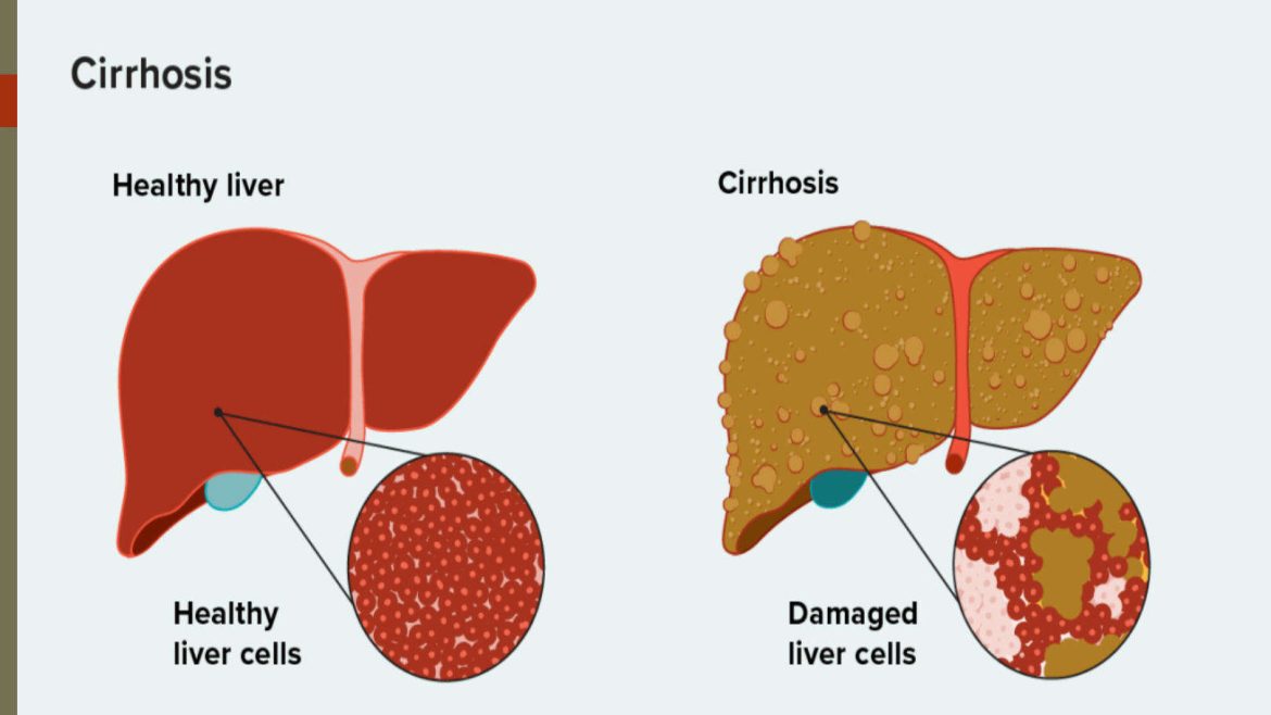 Portal Hypertension in Cirrhosis
