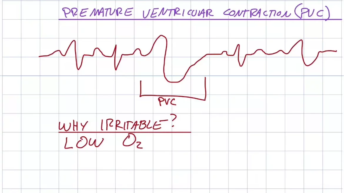 Premature Ventricular Contractions