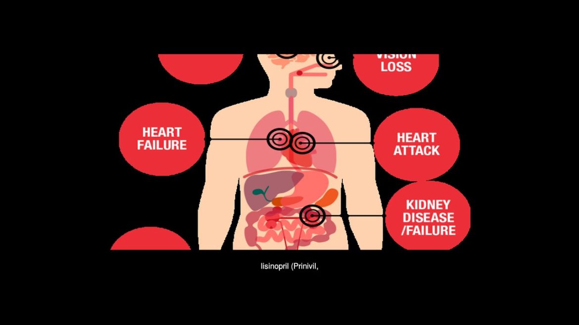 Stage 2 Hypertension