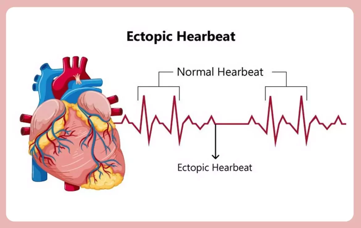 Triggers Ectopic