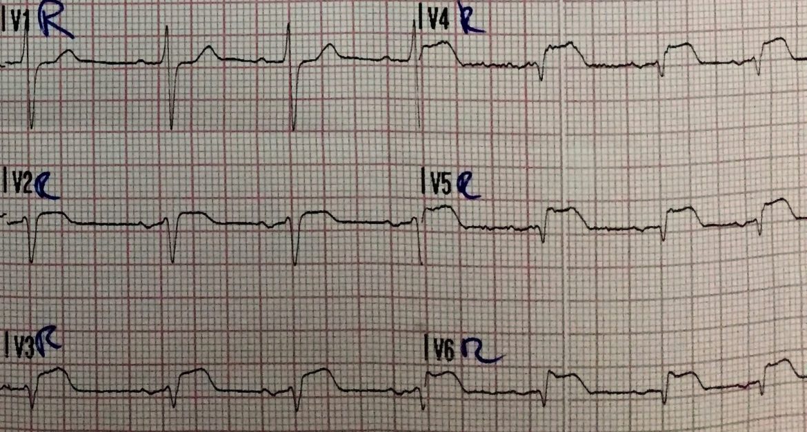 Ventricular Abnormalities