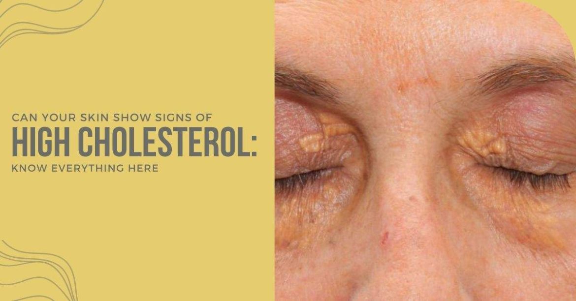 Can i exercise with high cholesterol cardiovasculardiseasehub