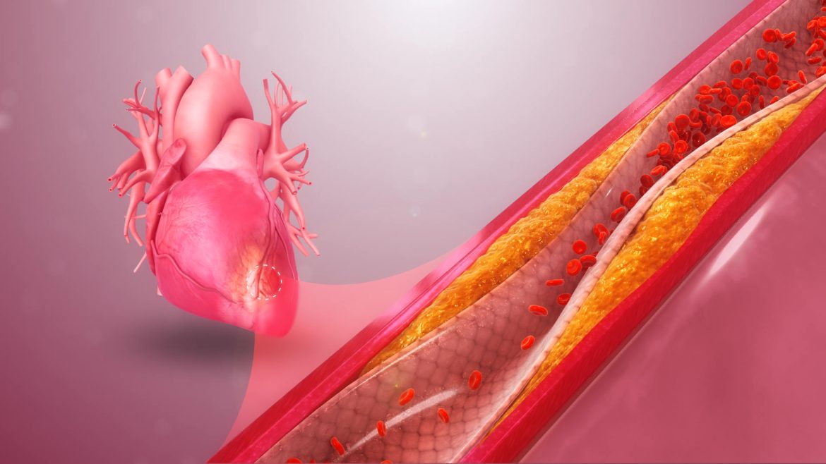 Acute Coronary Syndrome (ACS)