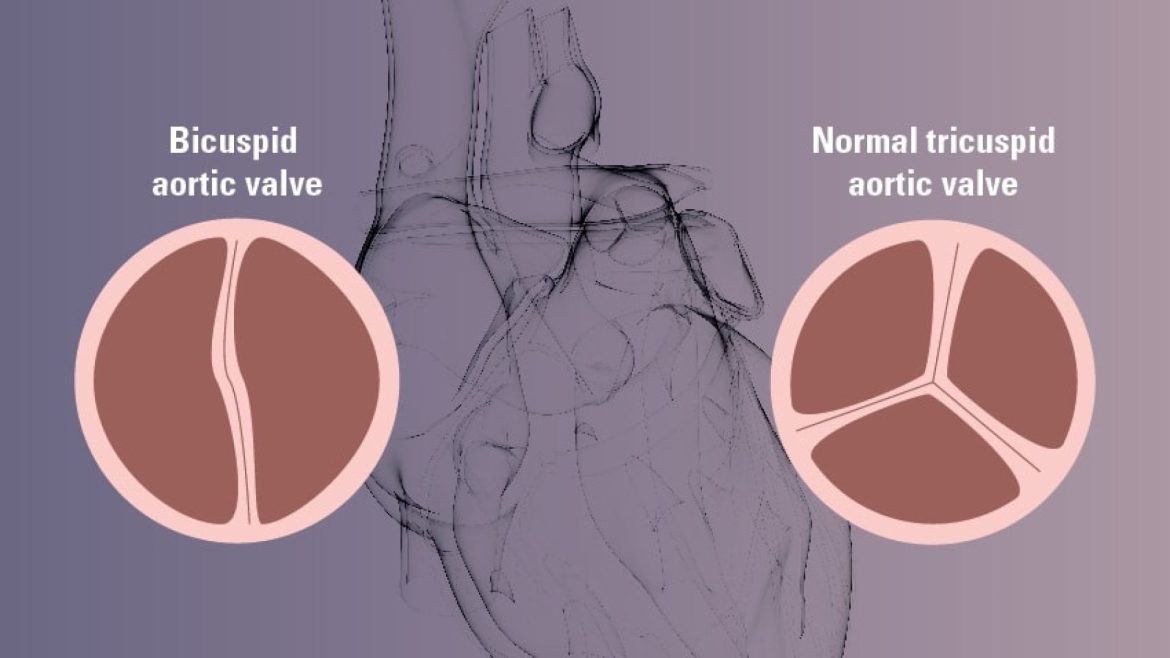 Aortic Valve Disease