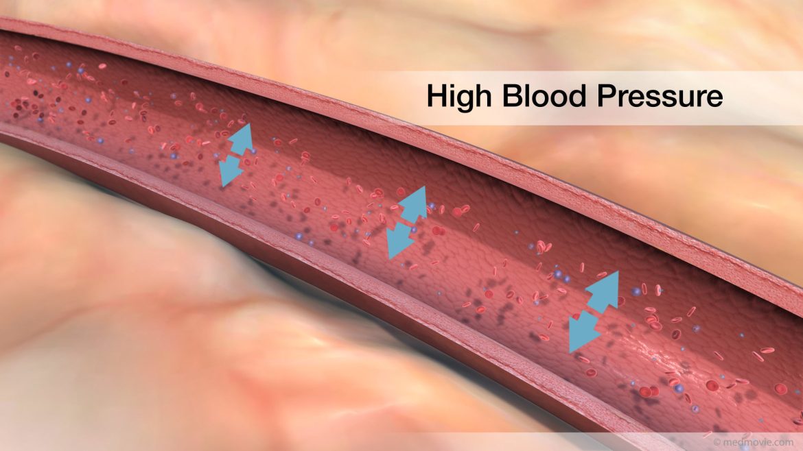 Artery Stenosis