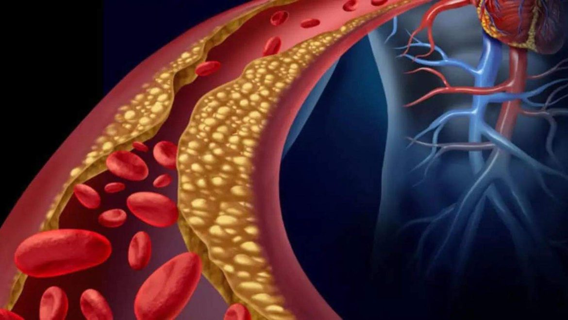 Atherosclerosis