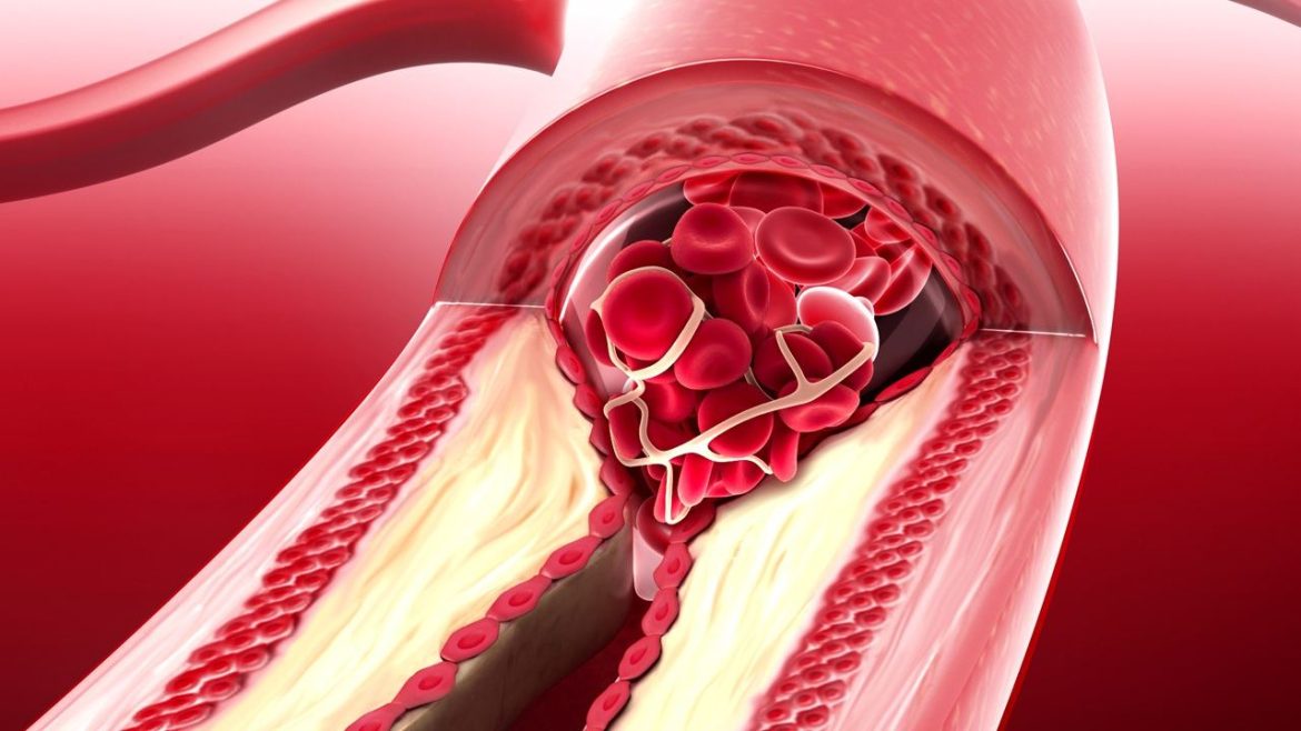 Coronary Artery Disease