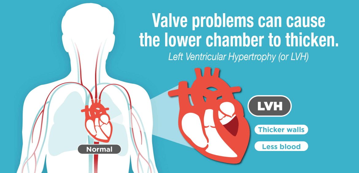 Left Ventricle Problems
