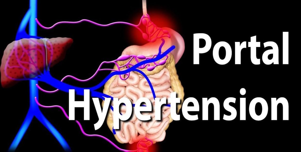 Portal Hypertension Naturally