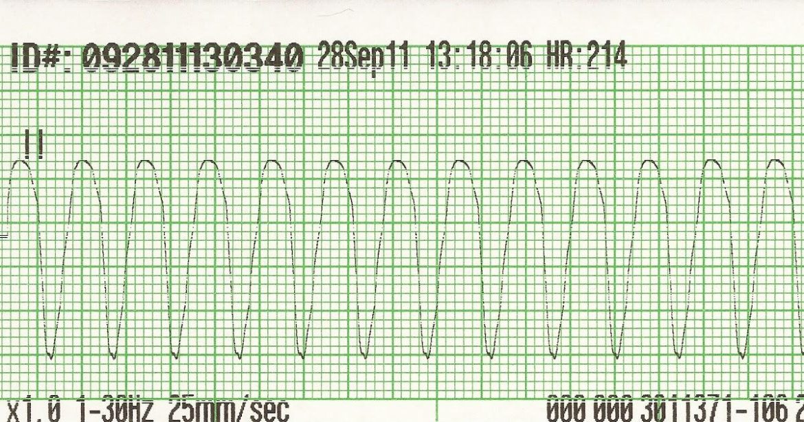 Pulseless Ventricular Fibrillation