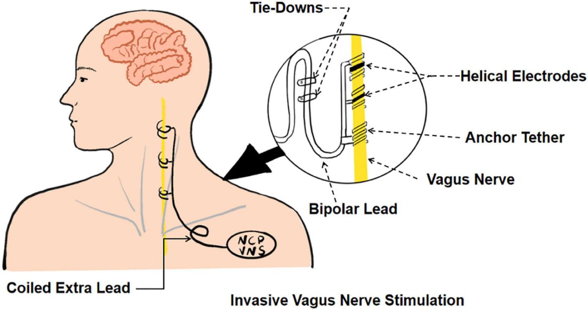Vagus Nerve Cause PVCs