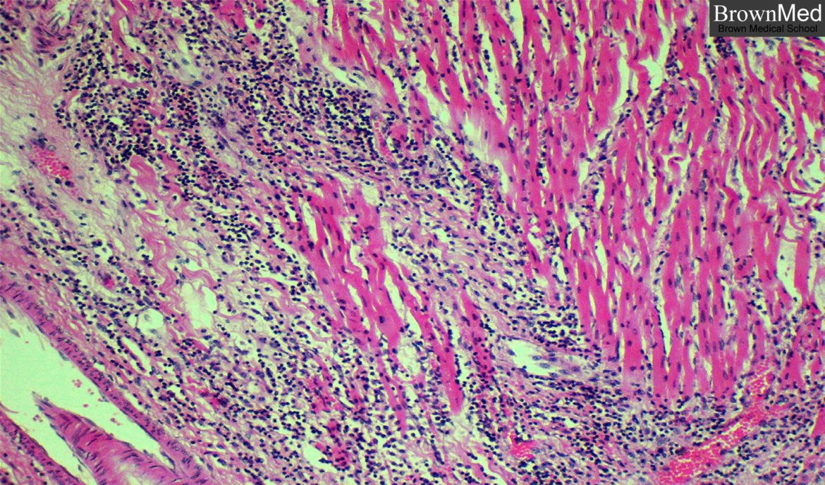 e COVID-19 Myocarditis