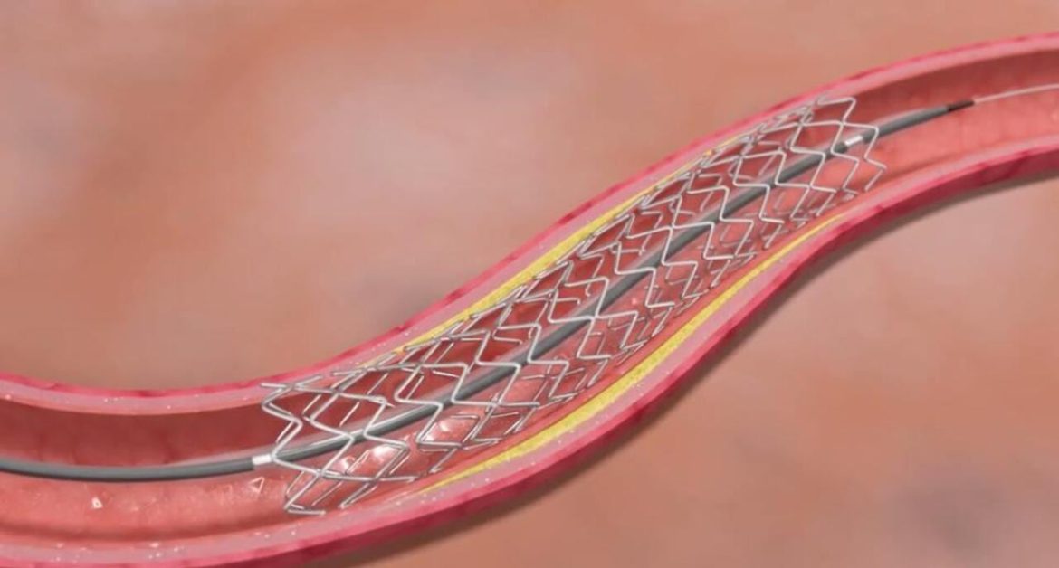 f Coronary Stents?