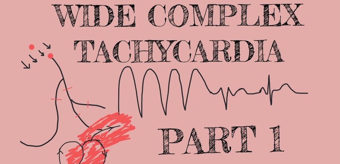 wide complex tachycardia