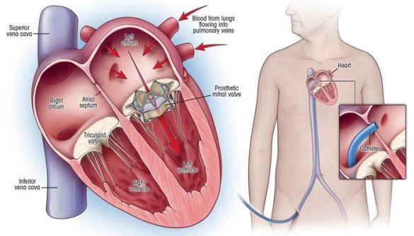How Long Can You Live With A Leaky Aortic Valve? - Cardiovasculardiseasehub
